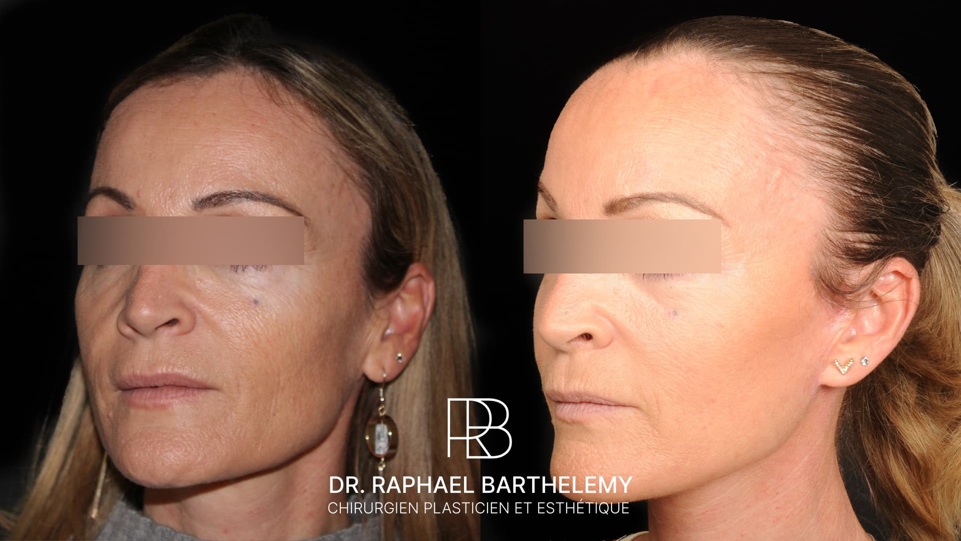 Résultat avant après d'un lifting du visage et du cou avec lipomodelage du visage réalisé par le Dr.Barthelemy à Marseille, vue de trois-quarts
